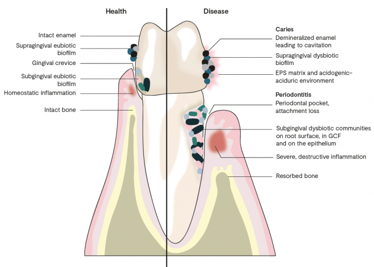 Tooth Dysbiosis